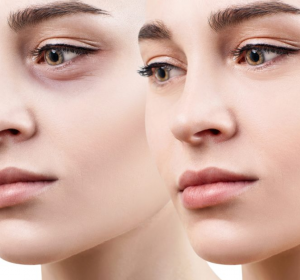 What is the blepharoplasty surgery? What is a good age for blepharoplasty?