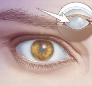 Cataract Surgery in Delhi: Vision Eye Centre