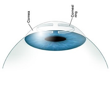 Cornea, Ocular Surface and Dry Eye Services