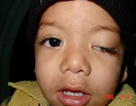 Pediatric Ophthalmologist in Delhi​: Vision Eye Centre